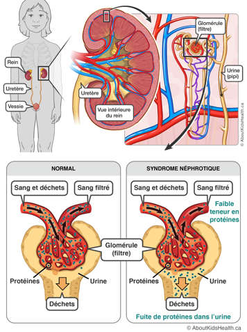 The glomeruli in nephrotic syndrome allow protein to leak into the urine.