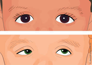 Close up of widely-spaced eyes and close up of eyes with ptosis