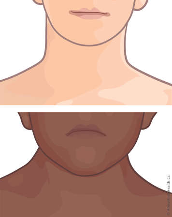 Child with normal neck compared to child with broad or webbed neck