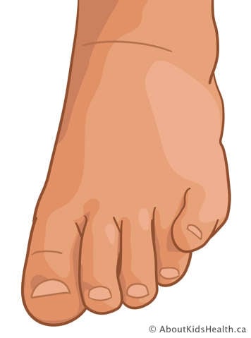 Illustration of a foot showing an overlapping 5th toe