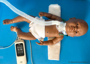 Baby with a tracheostomy tube with oximeter on their foot lying comfortably