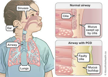 Illustration of mucus movement in normal airway and mucus buildup in airway with primary ciliary dyskinesia (PCD)