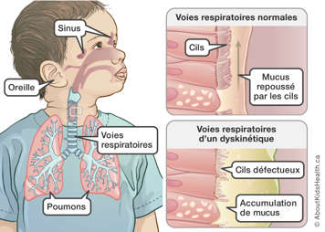 Illustration de l'accumulation de mucus dans les voies respiratoire d'une personne atteinte de dyskinésie ciliaire primaire