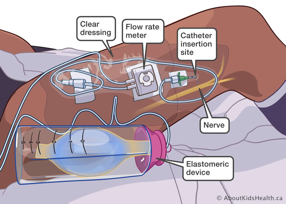 Elastomeric device showing the dressing, catheter, tubing and flow meter.
