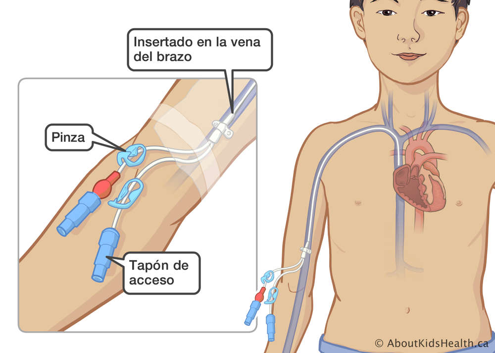 Catéter insertado en la vena del brazo de un niño con una pinza y un tapón de acceso en el exterior