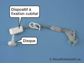 Dispositif à fixation cubital avec une disque