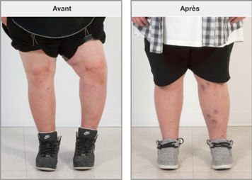 Les jambes avant et après la correction d’une difformité