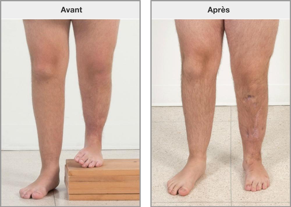 Les jambes avant et après allongement