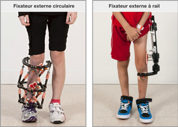 Un fixateur externe circulaire et un fixateur externe à rail