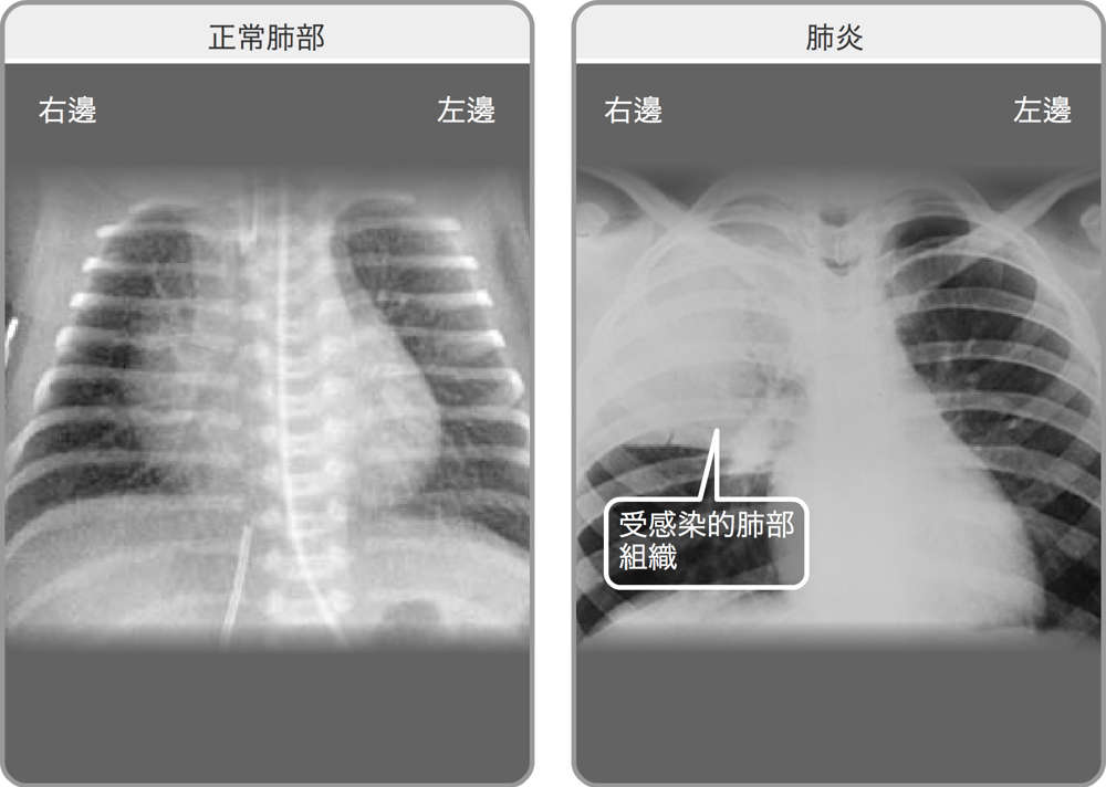 正常雙肺的X光透視影像，以及右肺感染肺炎的X光透視影像