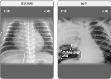 正常雙肺的X光透視影像,以及右肺感染肺炎的X光透視影像
