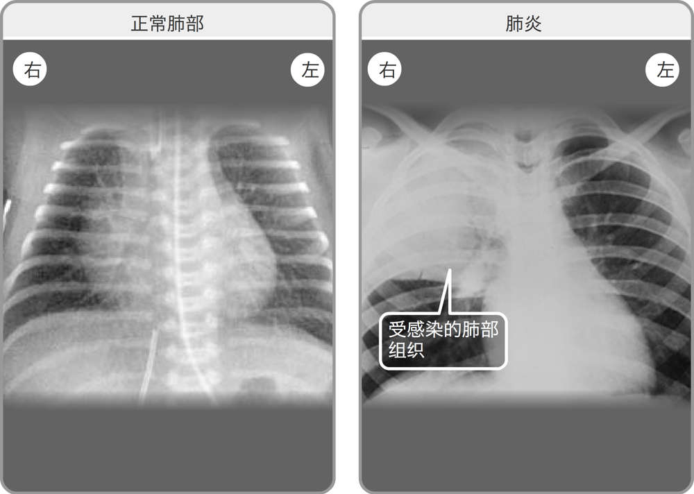正常双肺的X光透视影像，以及右肺感染肺炎的X光透视影像