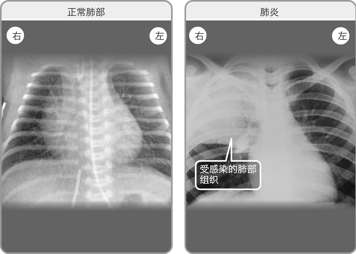 正常双肺的X光透视影像,以及右肺感染肺炎的X光透视影像