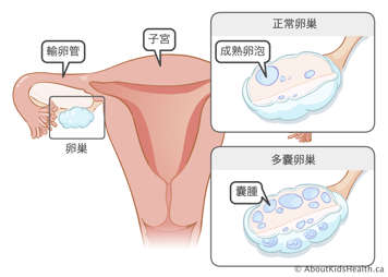 子宮、輸卵管和卵巢;帶有一個成熟卵泡的正常卵巢;以及含有囊腫的多囊卵巢