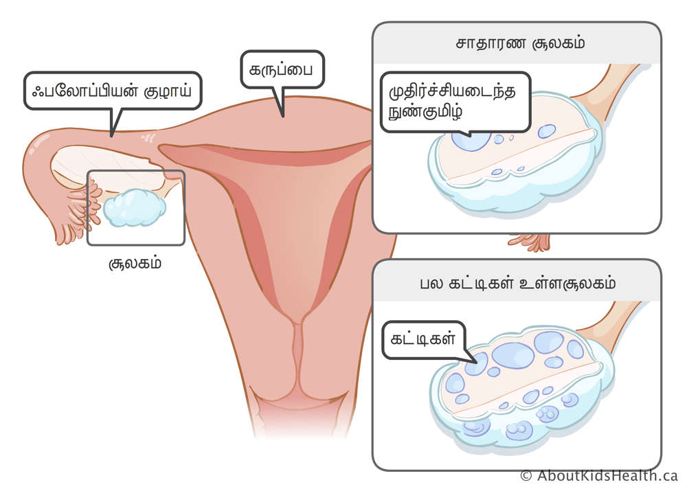 கருப்பை, பலோப்பியன் குழாய் மற்றும் சூலகம்; முதிர்ச்சியடைந்த சூல்பையைக் கொண்ட ஒரு சாதாரண சூலகம்; மற்றும் கட்டிகள் (cysts) கொண்ட பல்கட்டிகள் கொண்ட ஒரு சூலகம்