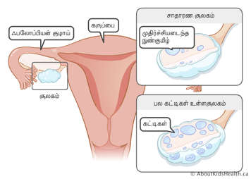 கருப்பை, பலோப்பியன் குழாய் மற்றும் சூலகம்; முதிர்ச்சியடைந்த சூல்பையைக் கொண்ட ஒரு சாதாரண சூலகம்; மற்றும் கட்டிகள் (cysts) கொண்ட பல்கட்டிகள் கொண்ட ஒரு சூலகம்