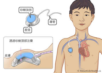 經皮下置入兒童胸腔主靜脈的埠裝置中的矽酮頂部、腔室和導管