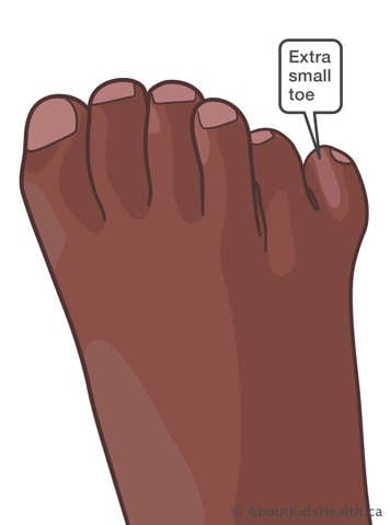 Photo showing post-axial polydactyly of the foot