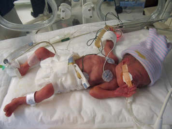 Moderately premature baby lying in an isolette