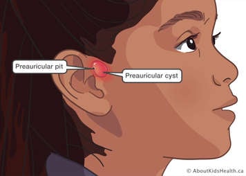 Close up of a child's face with a cyst in front of the ear
