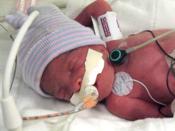 premature baby with striped hat