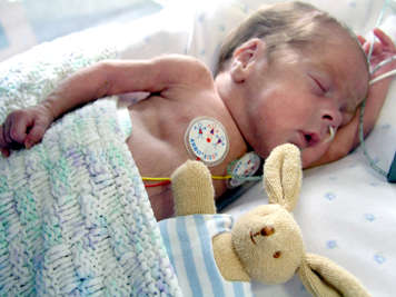 Premature baby sleeping on their side with NG tube in their nose and wires attached to pads on their chest