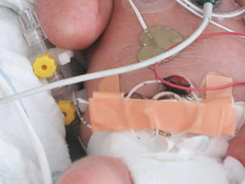 preemie with an umbilical venous catheter