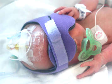 Preemie with scalp IV