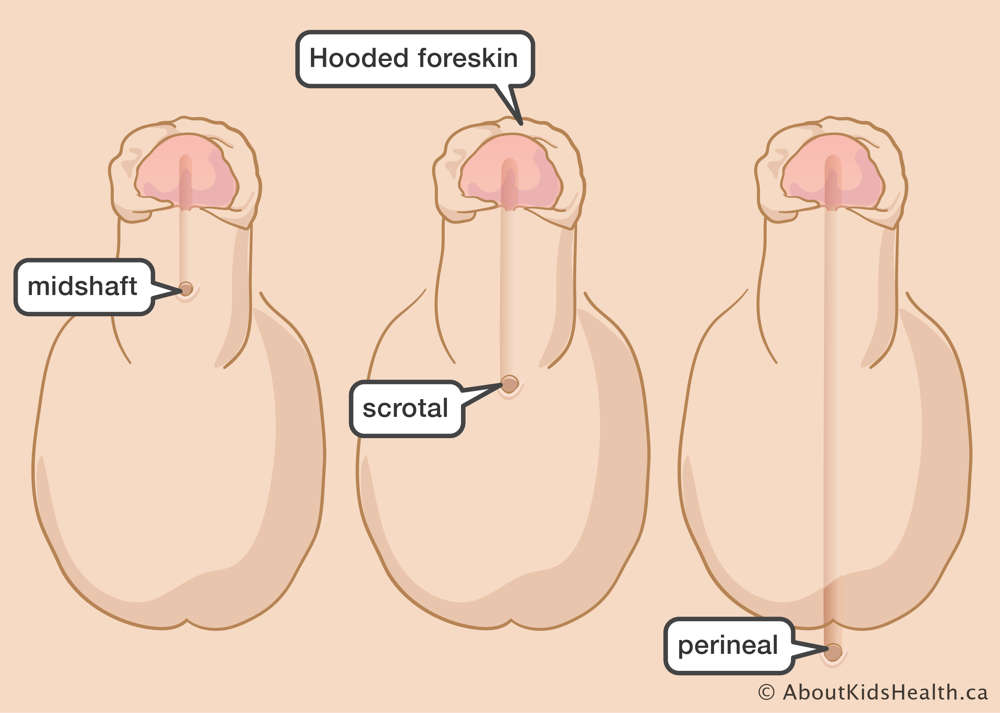 The urinary opening can be somewhere between the midshaft of the penis and perineum, and the foreskin is hooded.