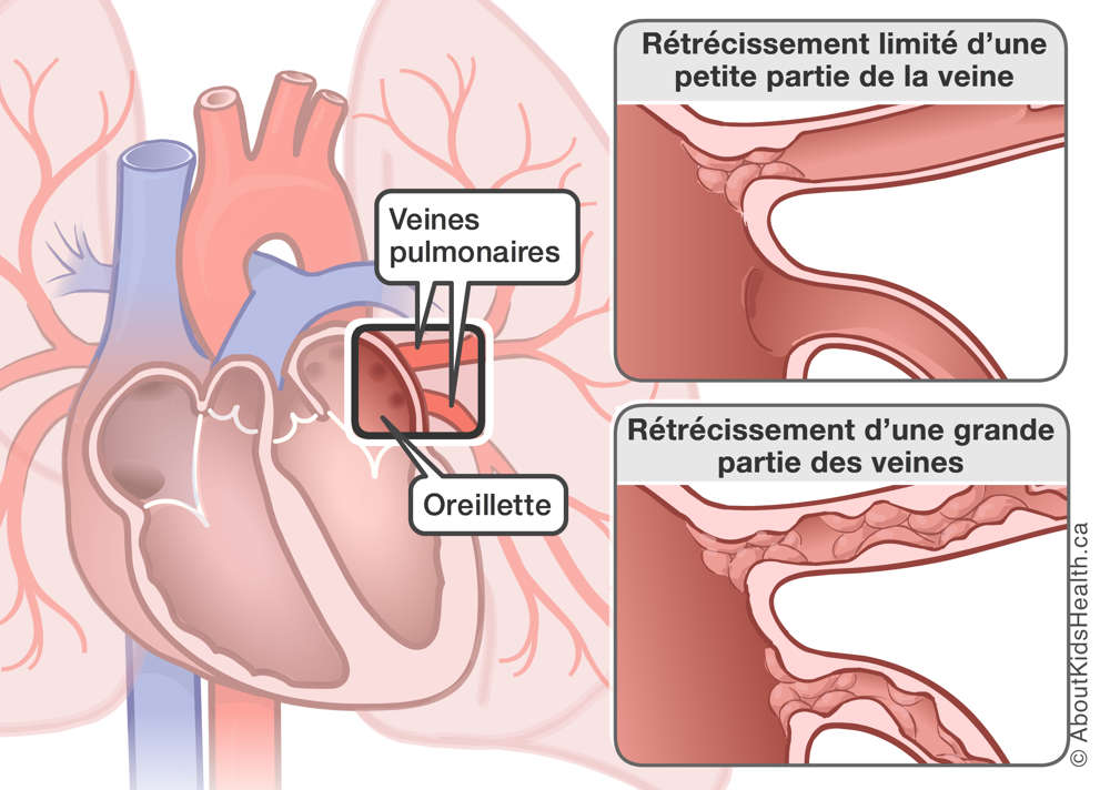 Illustration du rétrécissement limité d’une petite partie de la veine et du rétrécissement d’une grande partie des veines
