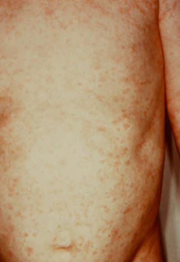 Child with rubella rash on torso