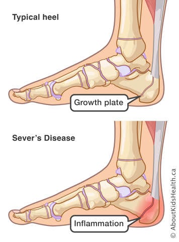 Illustration comparing a normal heel to the inflammation of the heel in Sever's disease