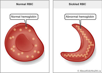 A red blood cell with normal hemoglobin molecules and a sickled red blood cell with abnormal hemoglobin molecules