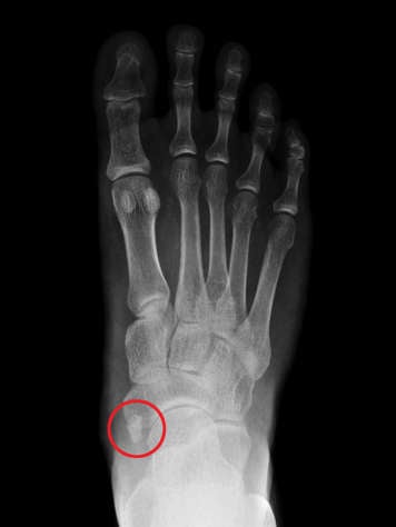 X-ray of foot showing an accessory navicular circled in red