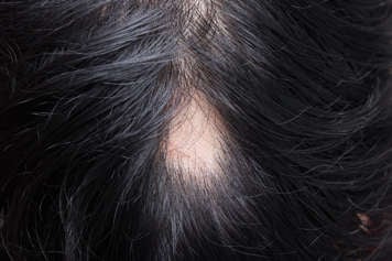 Closeup on back of person's head with long black hair and a small patch of hair loss in the middle