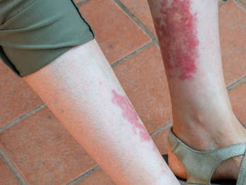 IgA vasculitis rash, which appears as clusters of red-purple spots, on an adult's inner calves