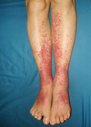 IgA vasculitis rash with small red-purple spots from just under someone's knees to their toes