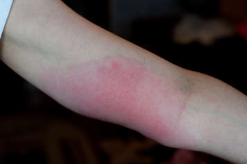 Lyme disease rash on an arm
