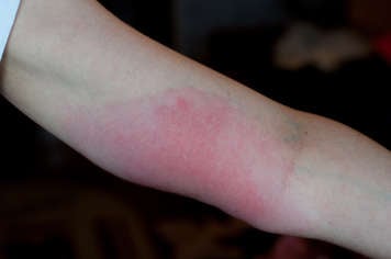 Lyme disease rash on an arm