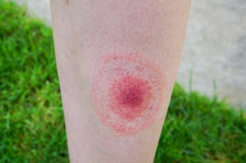 Lyme disease rash on a leg