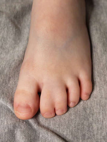 syndactyly of the toes