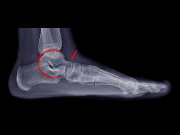X-ray showing a talocalcaneal (TC) coalition