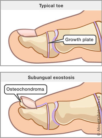 Illustration comparing a typical toe with one that has a subungual exostosis or osteochondroma