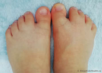 Photo showing syndactyly of the toes
