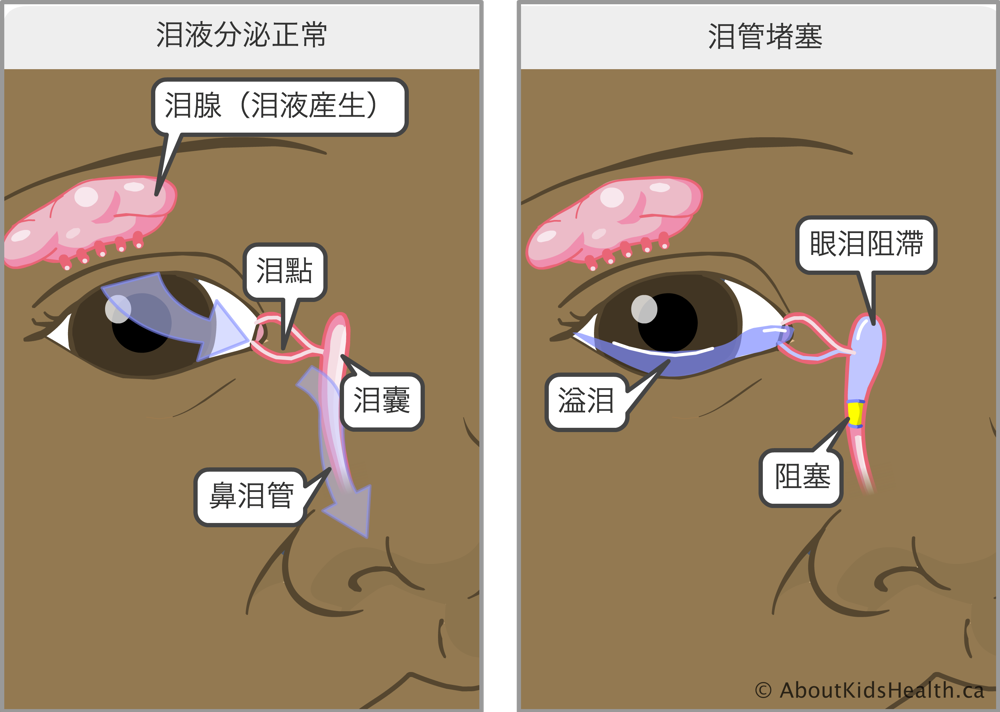 淚液分泌正常的眼睛，以及淚管阻塞的眼睛，後者會導致眼淚在淚囊中積聚，使患者多淚