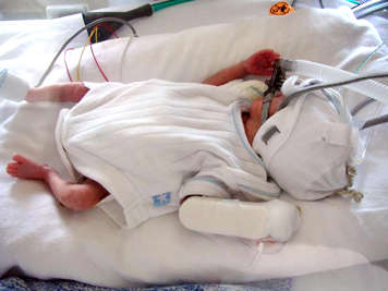 Premature baby in a white bed with a mask on their face connected to tubes to help with breathing