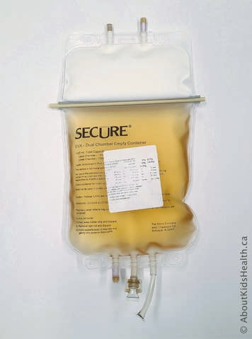 Parenteral nutrition bag with white lipid in upper portion and clear amber fluid in lower chamber