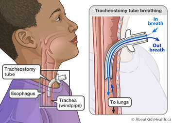 Illustration of tracheostomy tube breathing