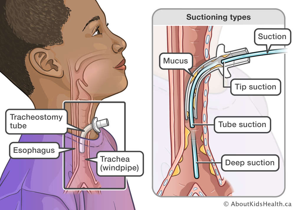 illustration showing tracheostomy tube in the trachea and how far to suction for tube suctioning