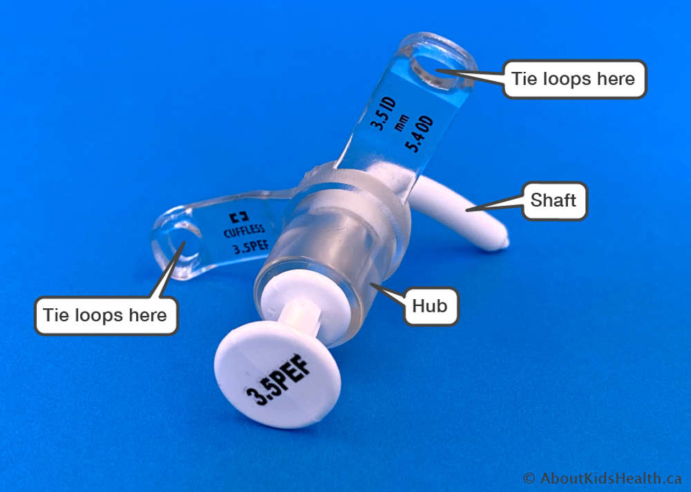 A tracheostomy tube showing the shaft, neck plate (flange), flange loop and hub (opening)